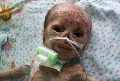 Baby accidentally burnt in Incubator abandoned by parents