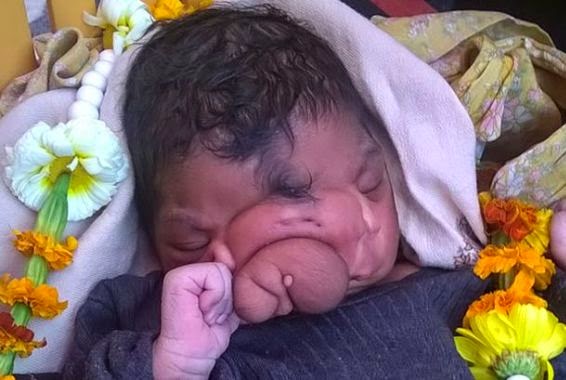 Indians worship girl born with a facial deformity like a god