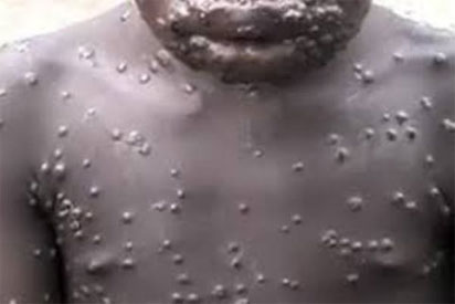 Terror in A/Ibom as Monkey Pox case confirmed in Uyo