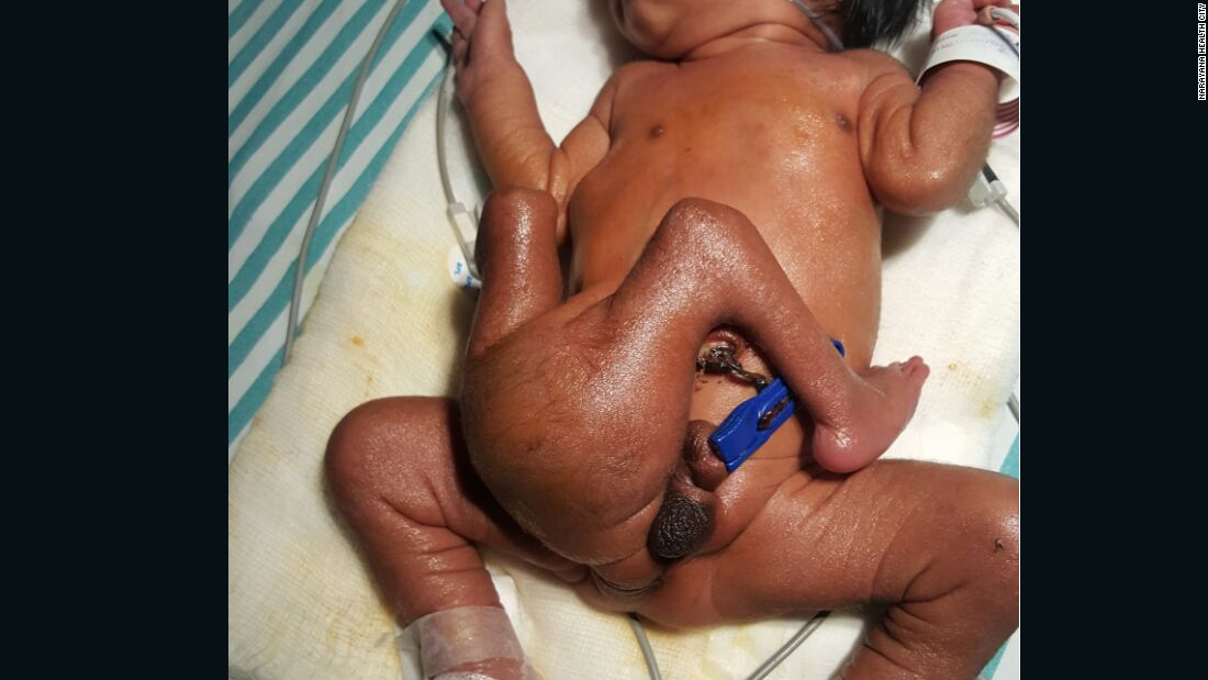 Baby Born With Four Legs And Two Penises Undergo Surgery