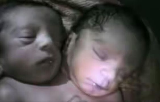 Co-joined twins born in India but dies after 30 hours