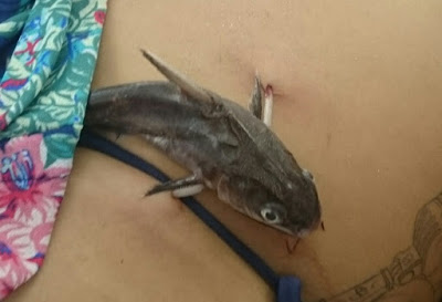 Catfish sticks into the belly of a swimming tourist in Brazil