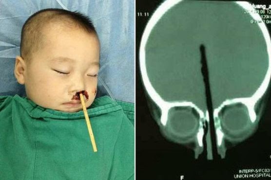 Photos: Boy has chopstick removed from brain after shoving it up his nose